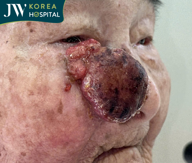 Cụ bà mắc khối u hoại tử trên mặt chảy máu lở loét gây đau đớn