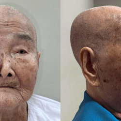 Giải cứu cụ bà 93 tuổi suy tim nặng khỏi khối u máu hoại tử lan sát vùng mắt