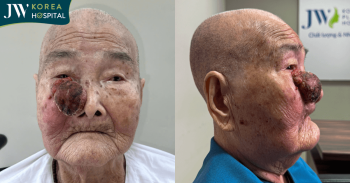 Giải cứu cụ bà 93 tuổi suy tim nặng khỏi khối u máu hoại tử lan sát vùng mắt