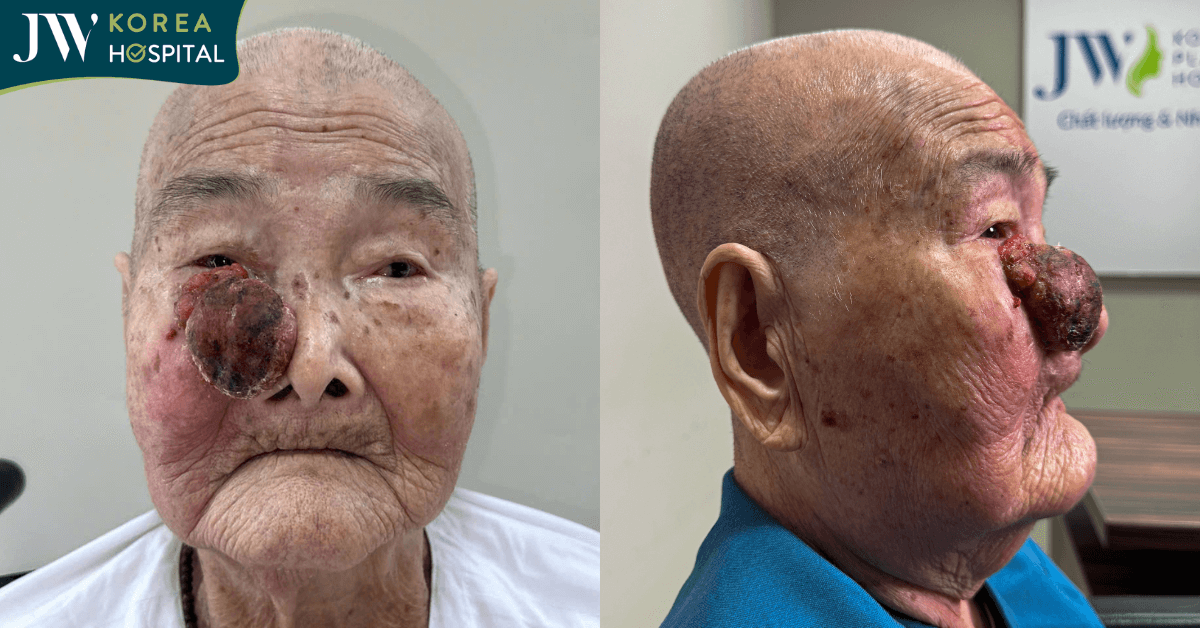 cụ bà suy tim vẫn phải mổ khối u máu trên mũi