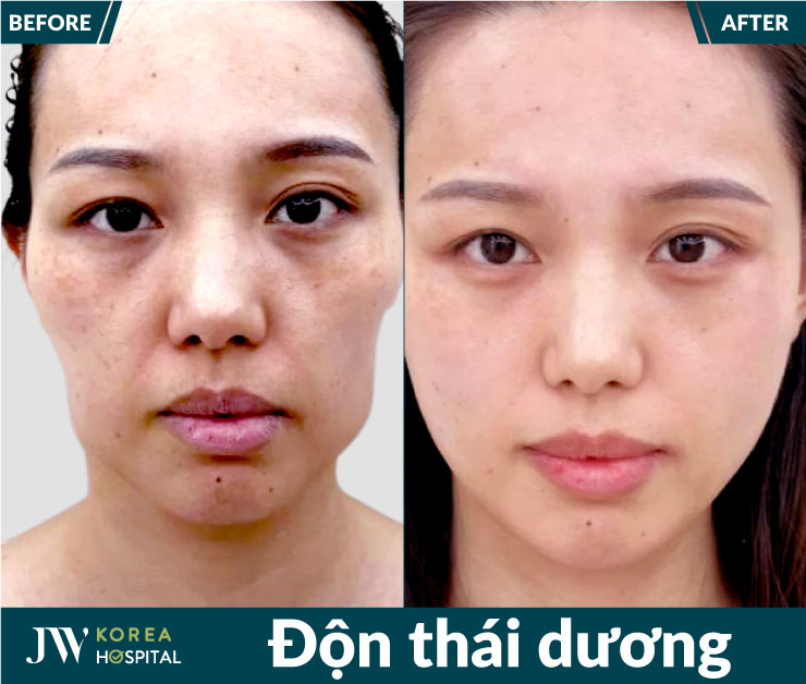 Hình ảnh khách hàng trước và sau khi thực hiện độn thái dương tại bệnh viện JW Hàn Quốc