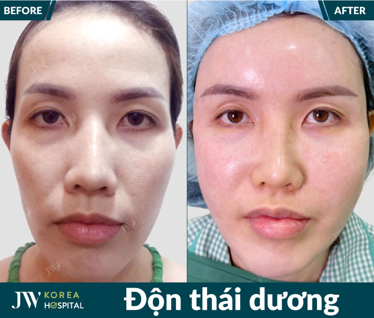 Hình ảnh khách hàng trước và sau khi độn thái dương tại bệnh viện JW