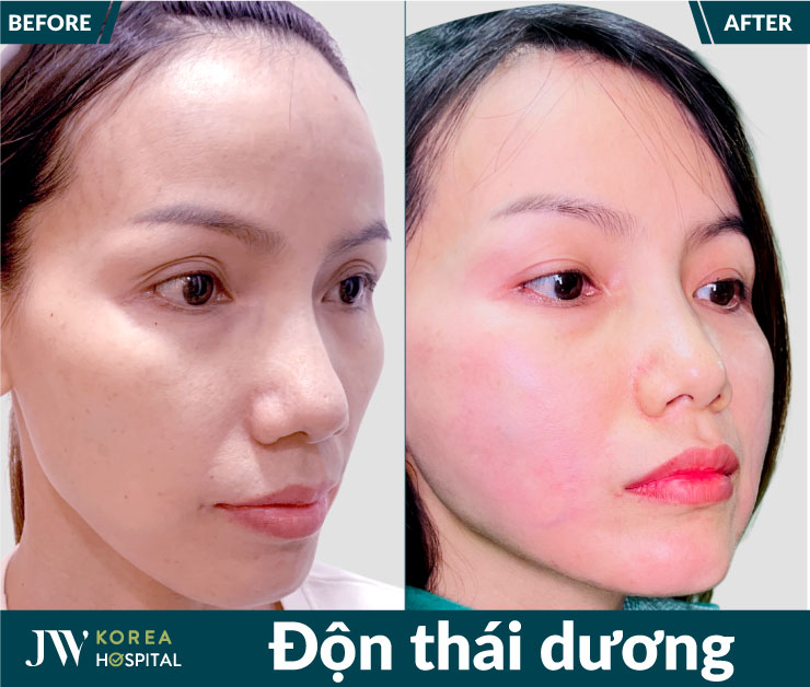 Hình ảnh khách hàng trước và sau khi độn thái dương tại bệnh viện JW Hàn Quốc