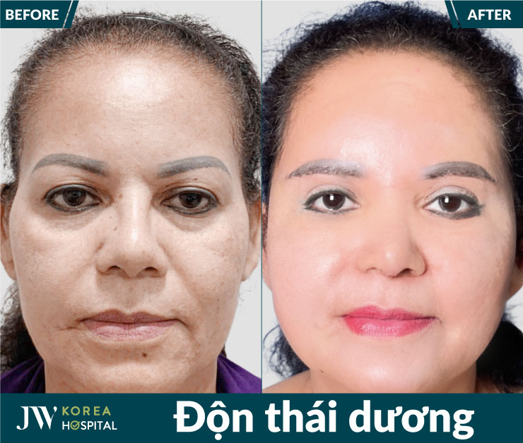 Diện mạo khách hàng thay đổi rõ rệt sau 1 quá trình thực hiện độn thái dương tại Bệnh viện JW