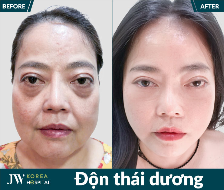 Độn thái dương giúp cải thiện lòi lõm vùng thái dương, cải thiện diện mạo