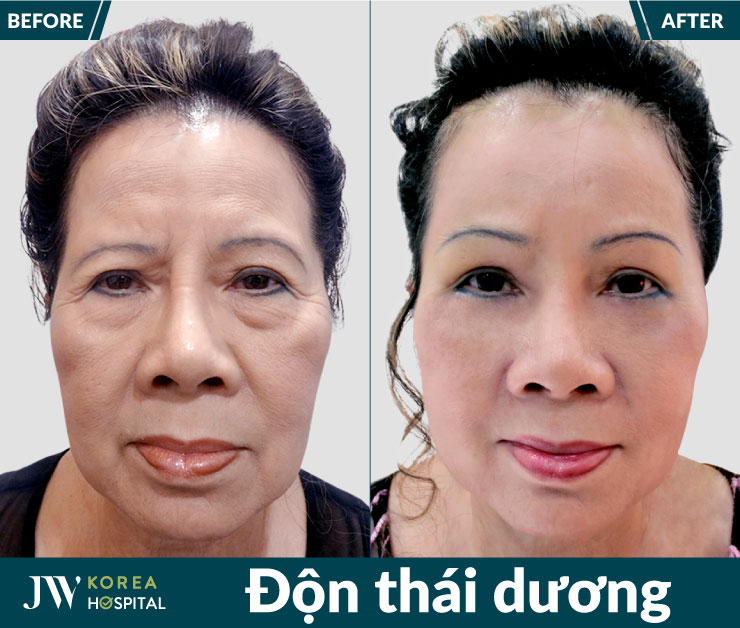 Kêt quả thay đổi diện mạo sau độn thái dương tại Bệnh viện JW