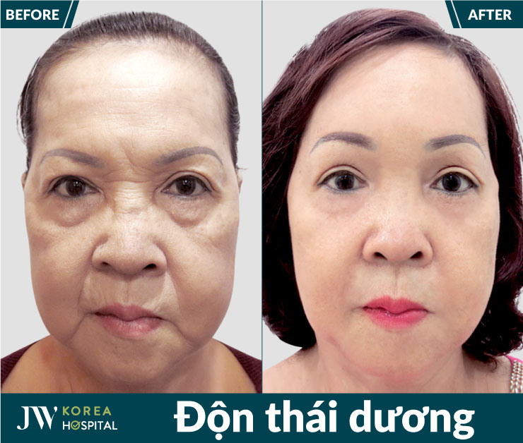 Độn thái dương giúp khắc phục tình trạng lòi, lõm, cải thiện diện mạo, tăng sự tự tin