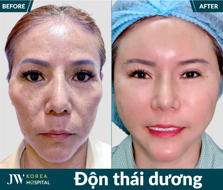 Hình ảnh khách hàng trước và sau khi thực hiện độn thái dương tại bệnh viện JW
