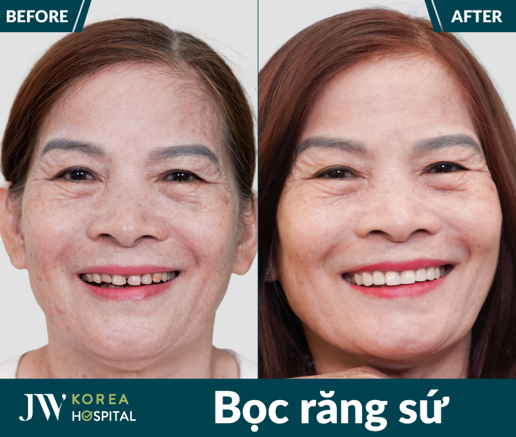 Hình ảnh trước và sau của khách hàng khi bọc răng sứ kỹ thuật số 4.0 tại Bệnh viện JW