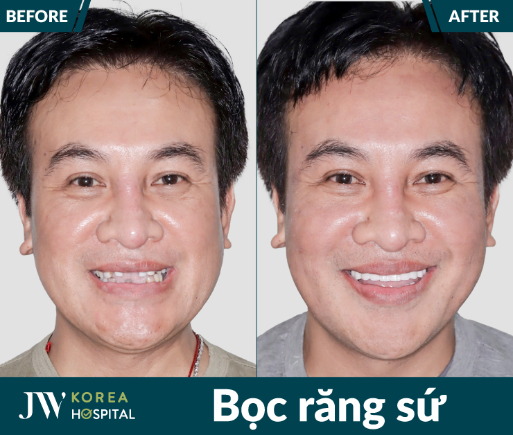 Bọc răng sứ tại Bệnh viện JW giúp sở hữu răng đẹp tinh tế chuẩn Hàn