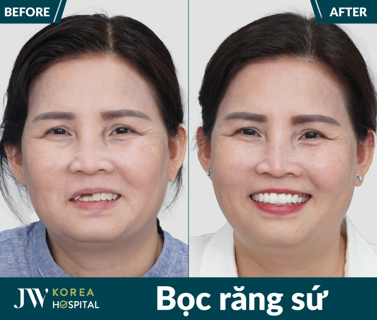 Hình ảnh khách hàng trước và sau bọc răng sứ kỹ thuật số 4.0 tại Bệnh viện JW