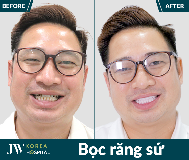 Kết quả bọc răng sứ kỹ thuật số 4.0 của khách hàng tại bệnh viện JW