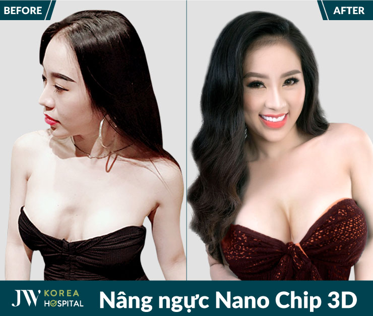 Hình ảnh trước và sau Nâng ngực Nano Chip 3D tại Bệnh viện JW Hàn Quốc