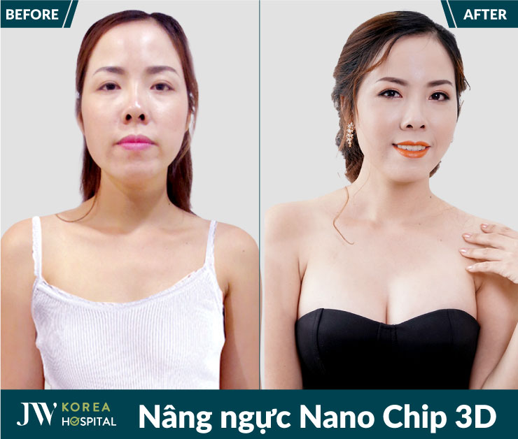 Hình ảnh trước và sau Nâng ngực Nano Chip 3D của khách hàng tại Bệnh viện JW