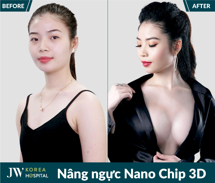 Hình ảnh trước và sau Nâng ngực Nano Chip 3D của khách hàng tại Bệnh viện JW Hàn Quốc