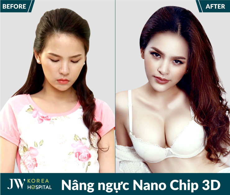 Khách hàng được bác sĩ có chứng chỉ hành nghề trực tiếp thăm khám và thực hiện Nâng ngực Nano Chip 3D