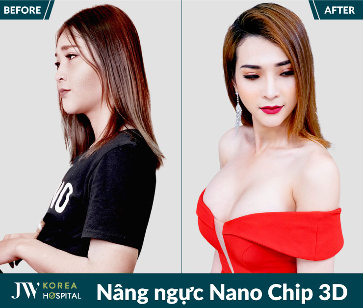 Nâng ngực Nano Chip 3D tại Bệnh viện JW giúp sở hữu vòng 1 quyến rũ, tự tin giao tiếp