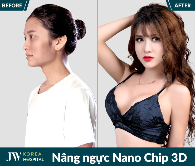 Khắc phục ngực xệ, lép, vòng 1 nhỏ, khiêm tốn với Nâng ngực Nano Chip 3D tại Bệnh viện JW