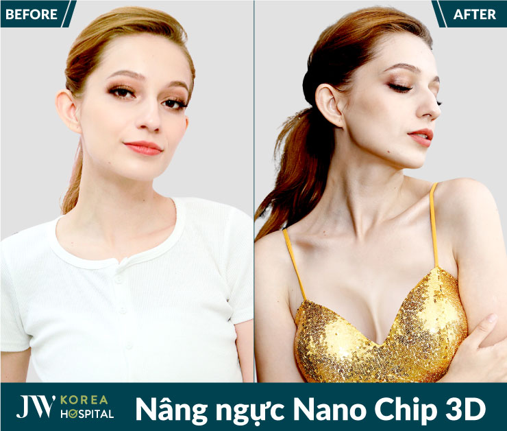 Hình ảnh trước và sau Nâng ngực Nano Chip 3D tại Bệnh viện JW
