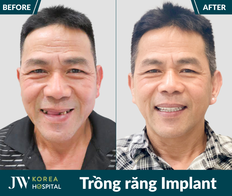 Hình ảnh trước và sau khi thực hiện trồng răng Implant của khách hàng tại Bệnh viện JW