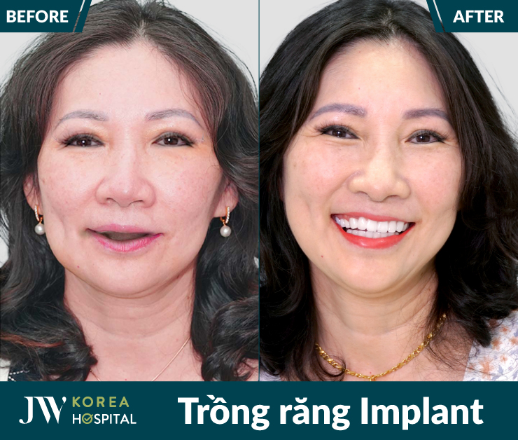 Cô chú U50 - U80 khôi phục răng mất nhanh chóng, ăn nhai thoải mái sau trồng răng Implant tại bệnh viện JW