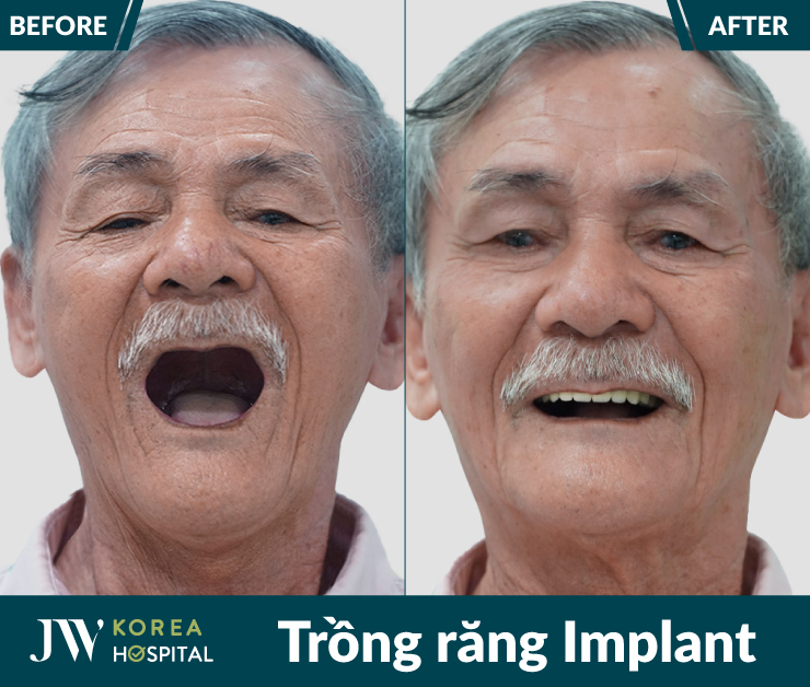 trồng răng Implant tại Bệnh viện JW được thực hiện 100% bởi bác sĩ có chứng chỉ hành nghề