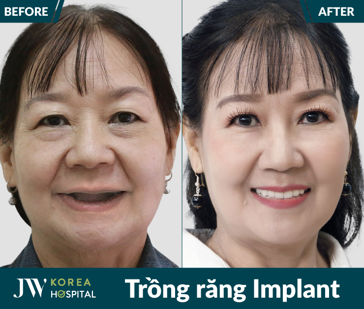 100% khách hàng hài lòng sau khi trồng răng Implant tại bệnh viện JW