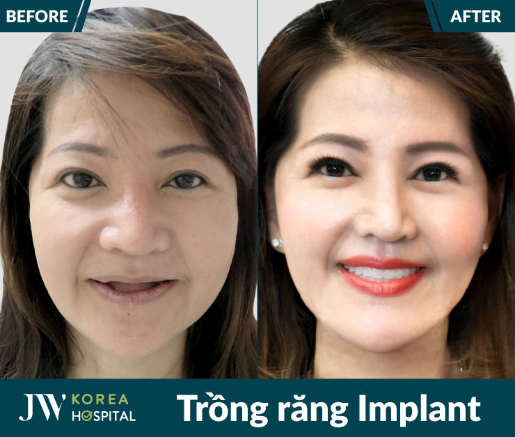 Hình ảnh trước và sau khi thực hiện trồng răng Implant tại Bệnh viện JW của khách hàng
