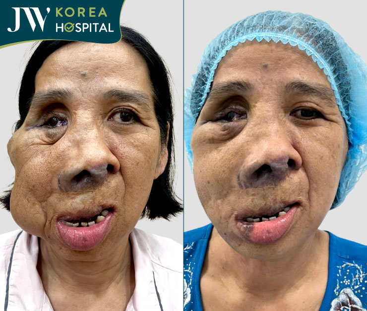 Hình ảnh cô Màng trước và sau phẫu thuật cắt u tại Bệnh viện JW