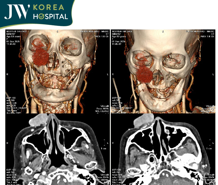 Hình ảnh chụp CT của cụ bà 93 tuổi bị mắc khối u mạch máu hoại tử sát mắt