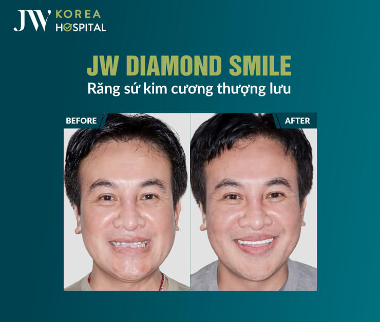 Răng sứ kim cương JW Diamond Smile tại Bệnh viện JW giúp cải thiện răng xỉn màu, mang lại nụ cười trắng sáng tự nhiên