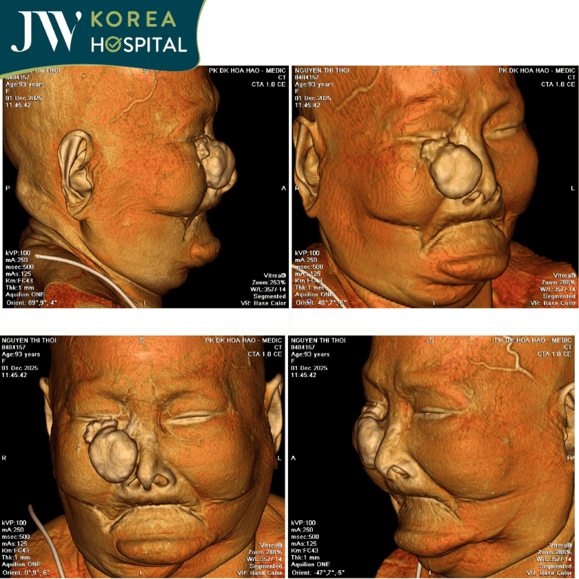 Kết quả chụp hình CT trước khi phẫu thuật
