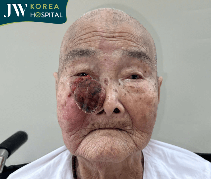 Khối u máu lấn sâu vào mí mắt cụ bà