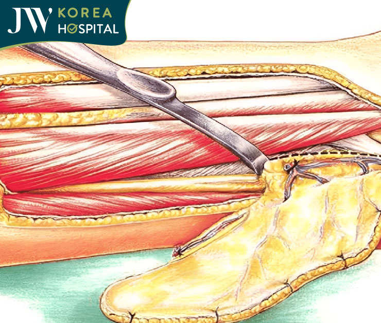 Kỹ thuật chuyển vạt Mustarde giúp che phủ khuyết hổng hiệu quả