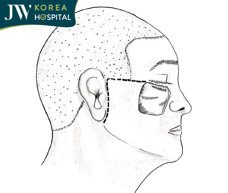 Kỹ thuật chuyển vạt Mustarde chuyên sâu