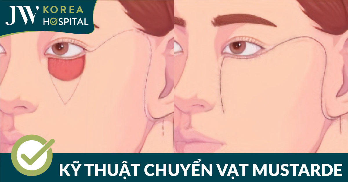 kỹ thuật chuyển vạt mustarde là kỹ thuật chuyên sâu đòi hỏi bác sĩ có tay nghề cao thực hiện