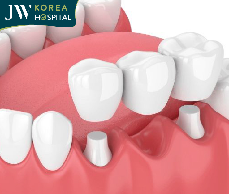 Mô phỏng bọc răng sứ kỹ thuật số 4.0 tại Bệnh viện JW