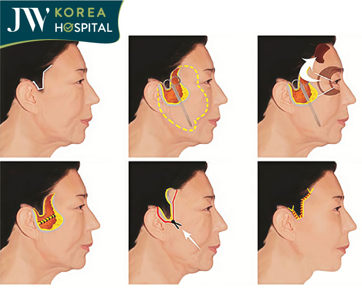 Mô phỏng độn thái dương tại Bệnh viện JW