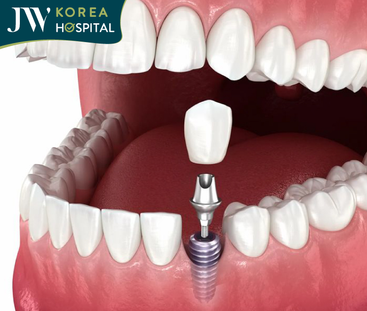 Mô phỏng hình ảnh trồng răng implant tại bệnh viện JW