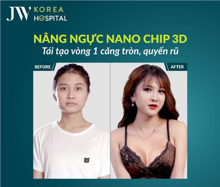 Nâng ngực Nano Chip 3D giúp tái tạo vòng 1 căng tròn quyến rũ