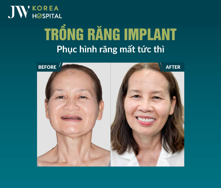 Trồng răng Implant tại Bệnh viện JW được bác sĩ có chứng chỉ hành nghề trực tiếp thăm khám và thực hiện