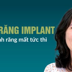 Trồng răng Implant tức thì – Phục hồi răng mất, ăn nhai bền vững tại JW