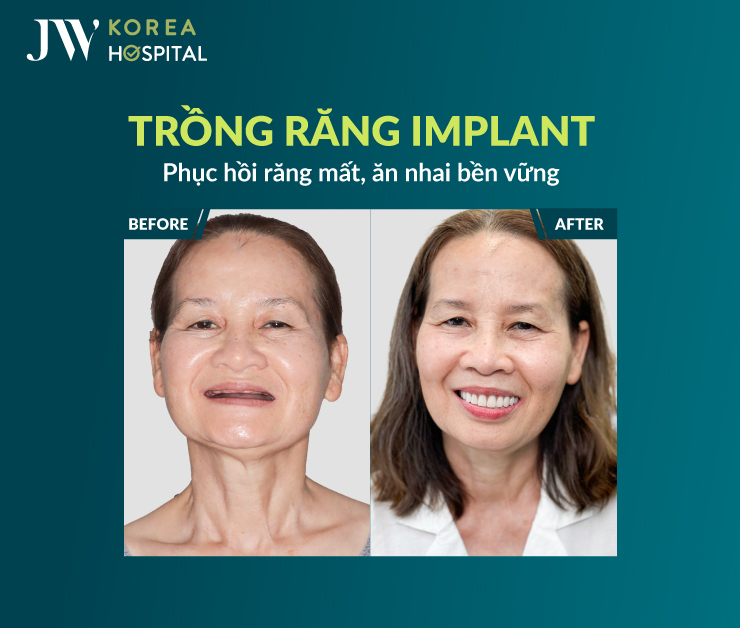 Cô chú U50 - U80 sở hữu răng chắc khỏe, ăn nhai thoải mái, cười tự tin với Trồng răng Implant tại JW