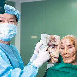 Cụ bà 90 tuổi mang khối u chân mày lở loét được phẫu thuật miễn phí tại Bệnh viện JW