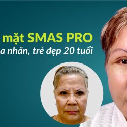Căng da mặt SMAS Pro tại JW – Trẻ hóa toàn diện, giữ nét tự nhiên