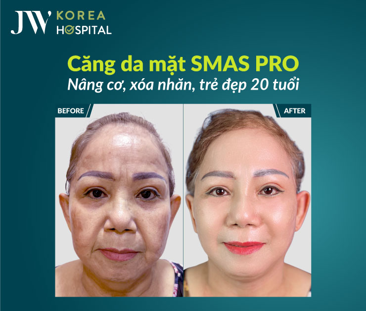 Căng da mặt SMAS Pro tại Bệnh viện JW giúp trẻ hóa bền vững theo thời gian
