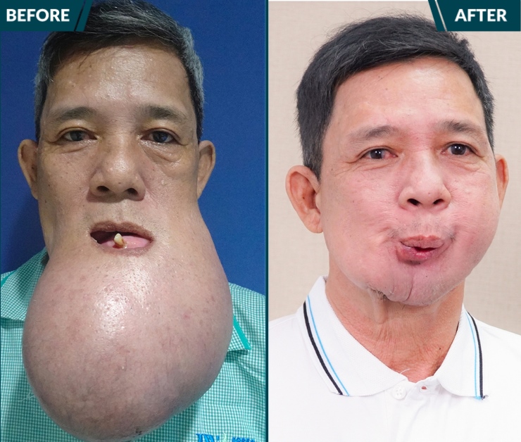 Chú Lê Quang Khanh - Bệnh nhân U nguyên bào men được tiếp nhận và điều trị thành công tại Bệnh viện JW 