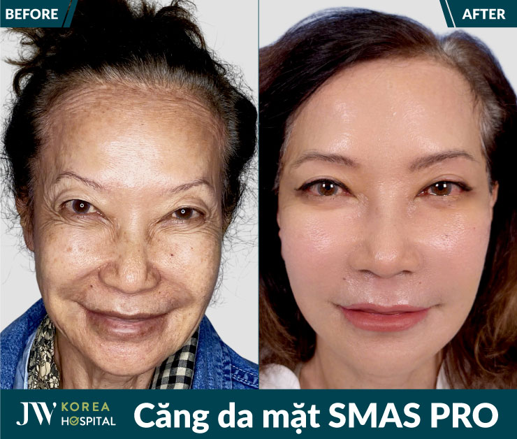 Kỹ thuật căng da mặt SMAS tại bệnh viện JW giúp gương mặt săn chắc, tự nhiên hơn