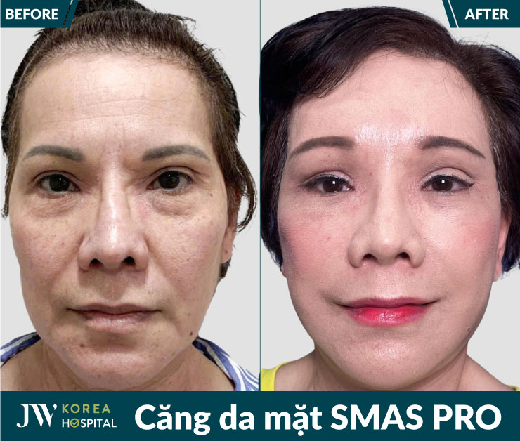 Căng da mặt SMAS Pro tại bệnh viện JW cải thiện tình trạng chảy xệ và rãnh cười sâu