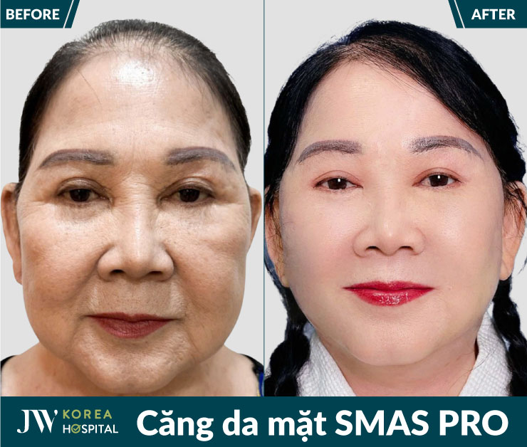 Căng da mặt SMAS Pro tại Bệnh viện JW giúp nâng cơ và trẻ hóa gương mặt